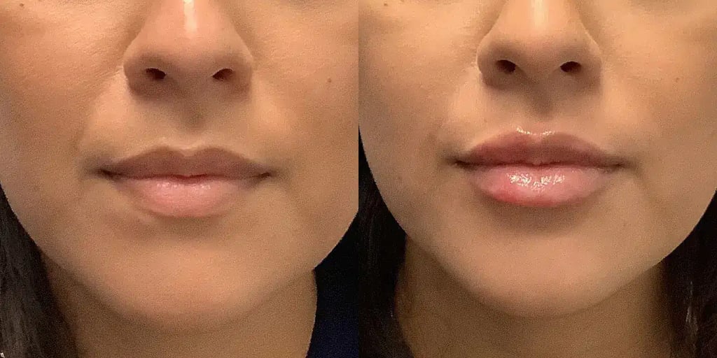 dermal Fillers aaa before and after photos by revitalize skinmd in waco tx