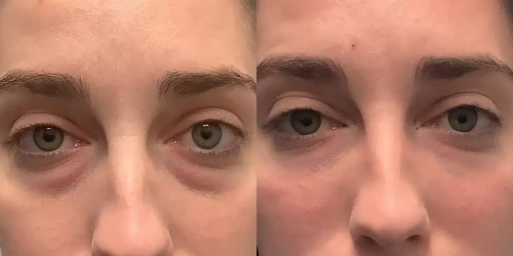 dermal Fillers aaa before and after photos by revitalize skinmd in waco tx