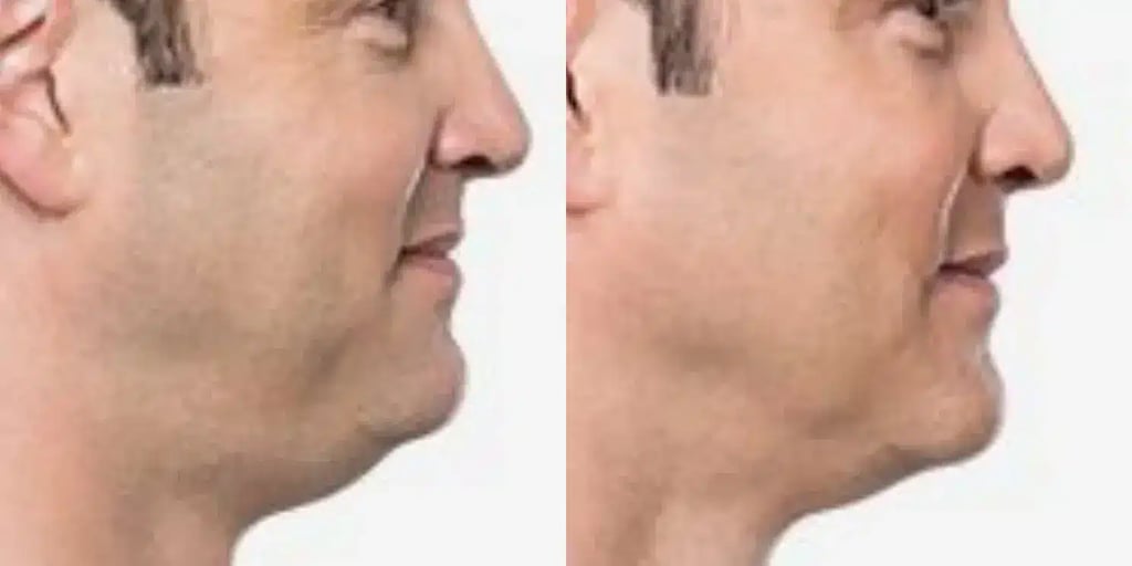 dermal Fillers aaa before and after photos by revitalize skinmd in waco tx