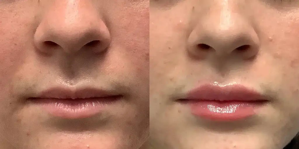 dermal Fillers aaa before and after photos by revitalize skinmd in waco tx