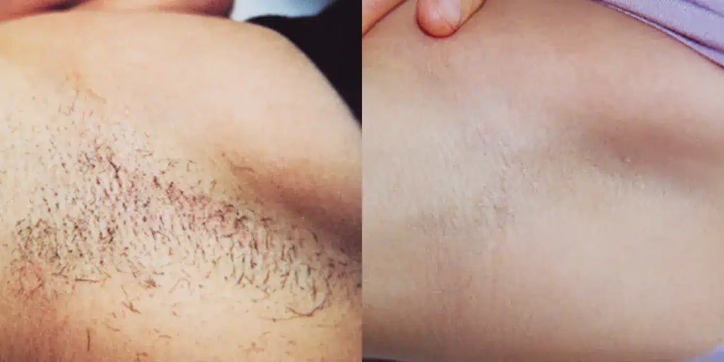 laser hair removal before and after photos by revitalize skinmd in waco tx