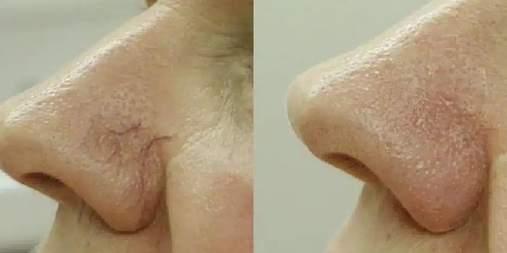 laser vein removal before and after photos by revitalize skinmd in waco tx