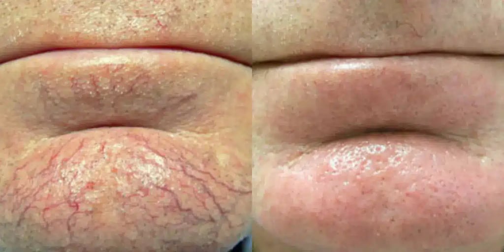 laser vein removal before and after photos by revitalize skinmd in waco tx