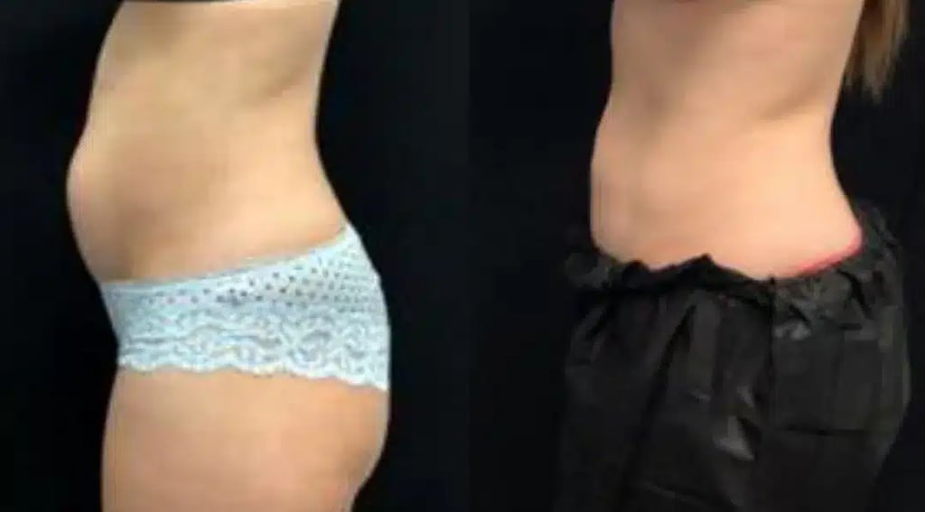 coolsculpting elite before and after photos by revitalize skinmd in waco tx