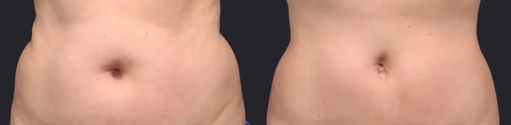 coolsculpting elite before and after photos by revitalize skinmd in waco tx