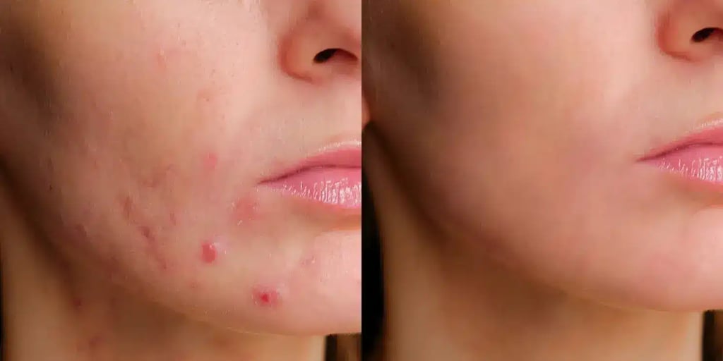 facials before and after photos by revitalize skinmd in waco tx