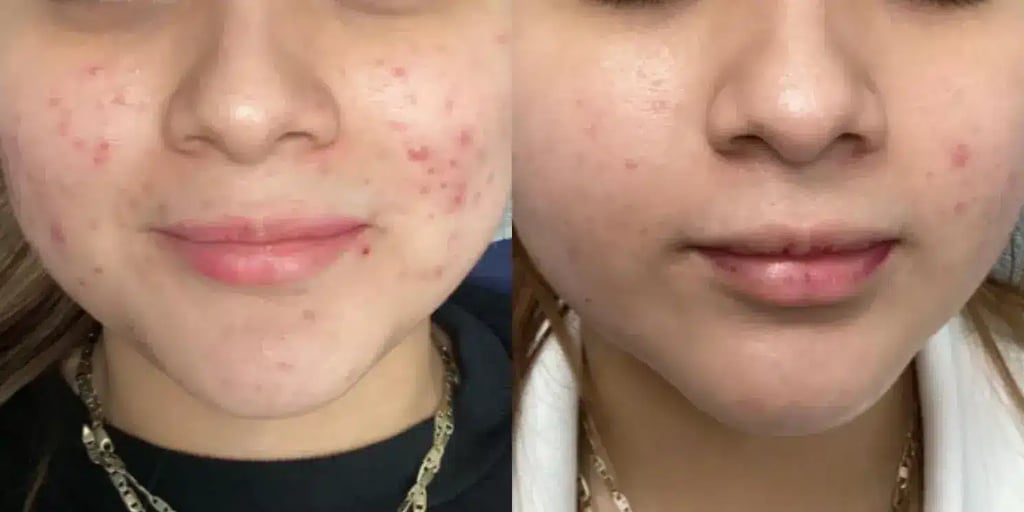 facials before and after photos by revitalize skinmd in waco tx