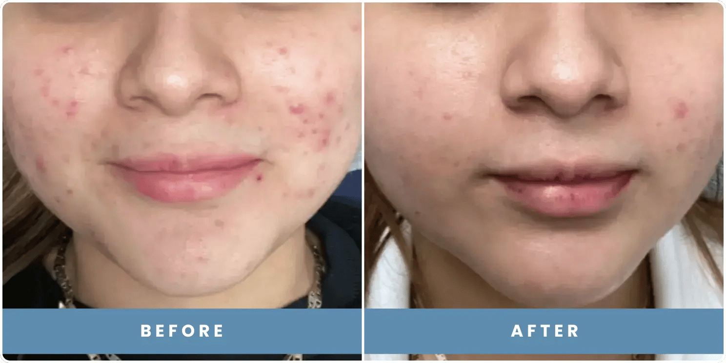 patient before and after results at revitalize skinmd patient before and after results at revitalize skinmd