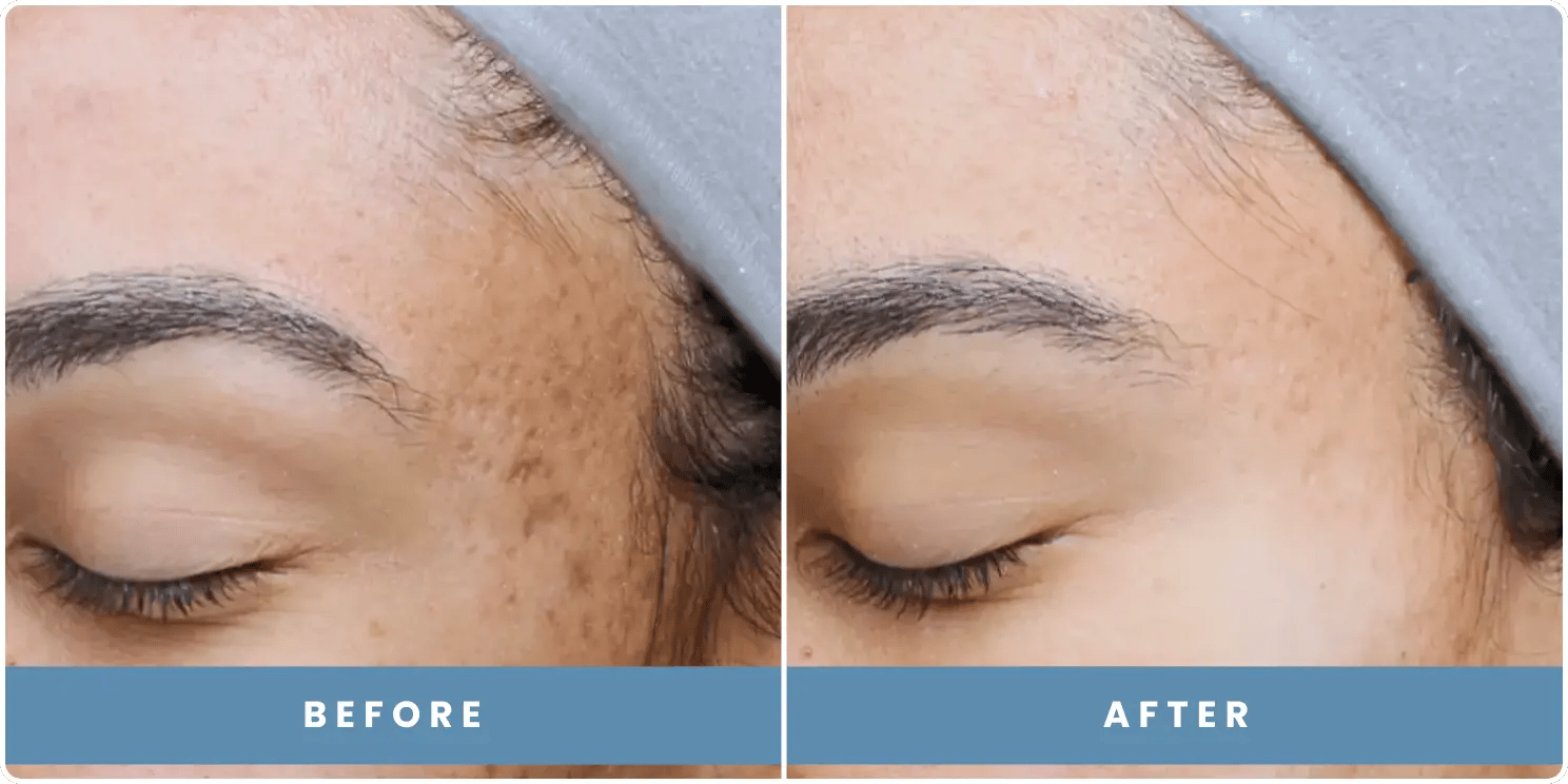patient before and after results at revitalize skinmd patient before and after results at revitalize skinmd