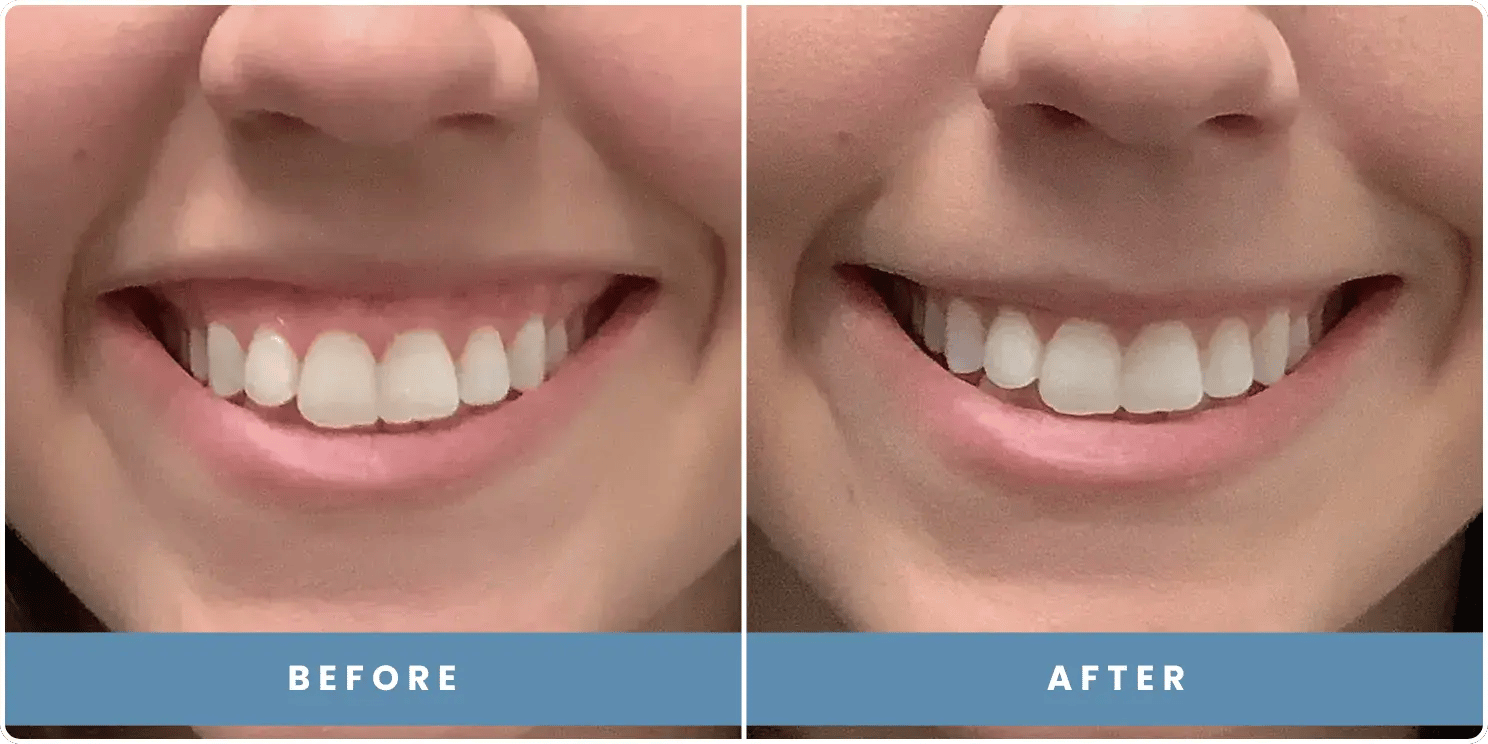 patient before and after results at revitalize skinmd patient before and after results at revitalize skinmd