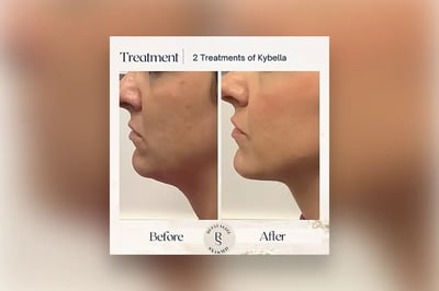 Say Goodbye to Double Chins with Kybella