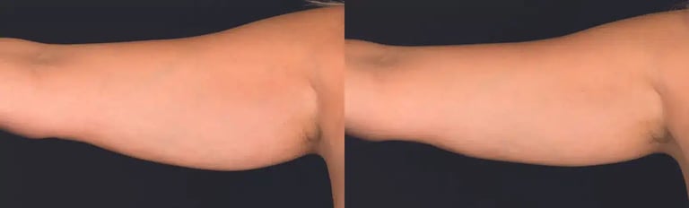 coolsculpting elite before and after photos by revitalize skinmd in waco tx coolsculpting elite before and after photos by revitalize skinmd in waco tx